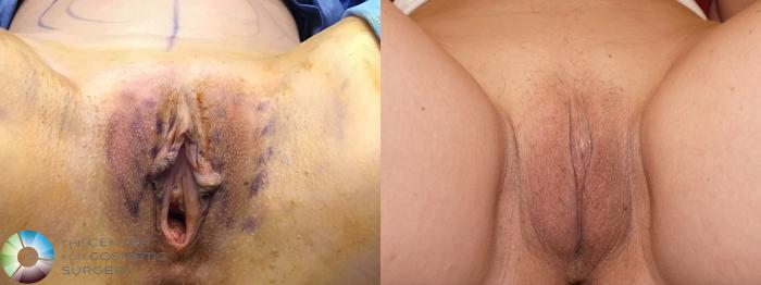 Before & After Labiaplasty Case 11944 Recumbent in Denver and Colorado Springs, CO
