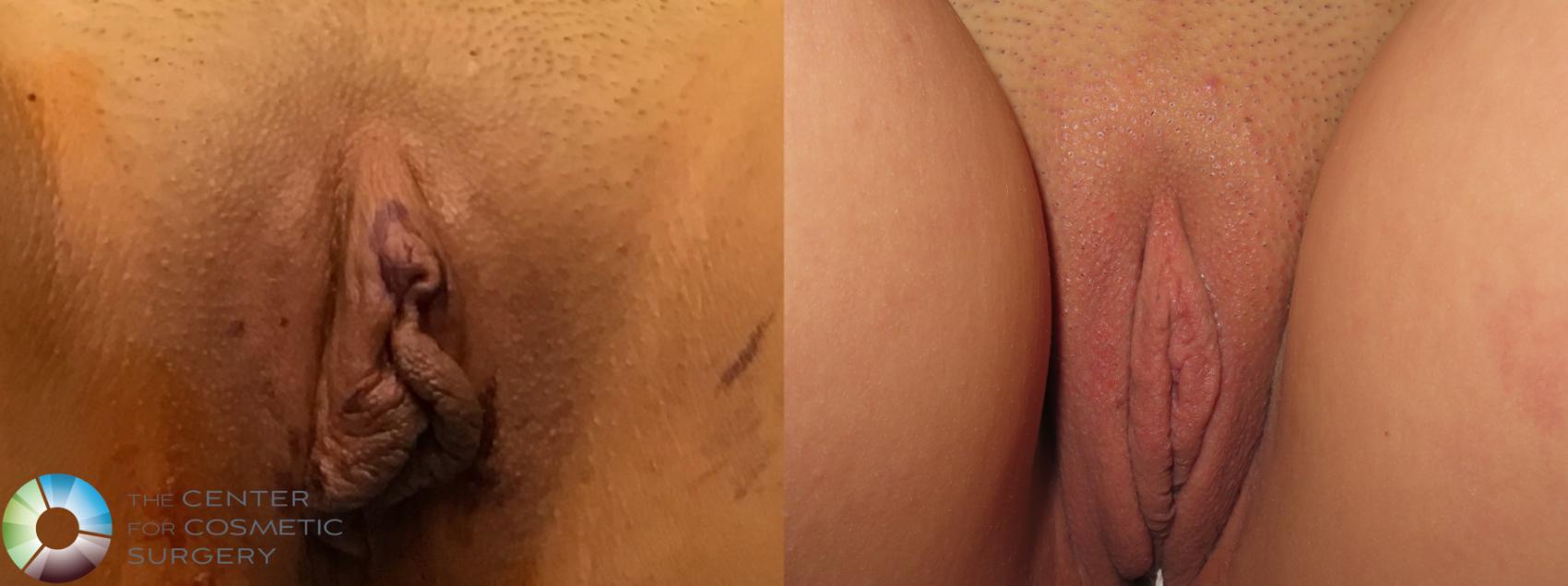 Before & After Labiaplasty Case 12087 Recumbent in Denver and Colorado Springs, CO