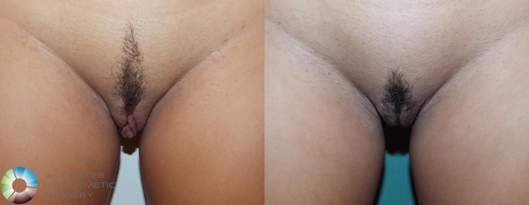 Before & After Labiaplasty Case 739 View #1 in Denver and Colorado Springs, CO