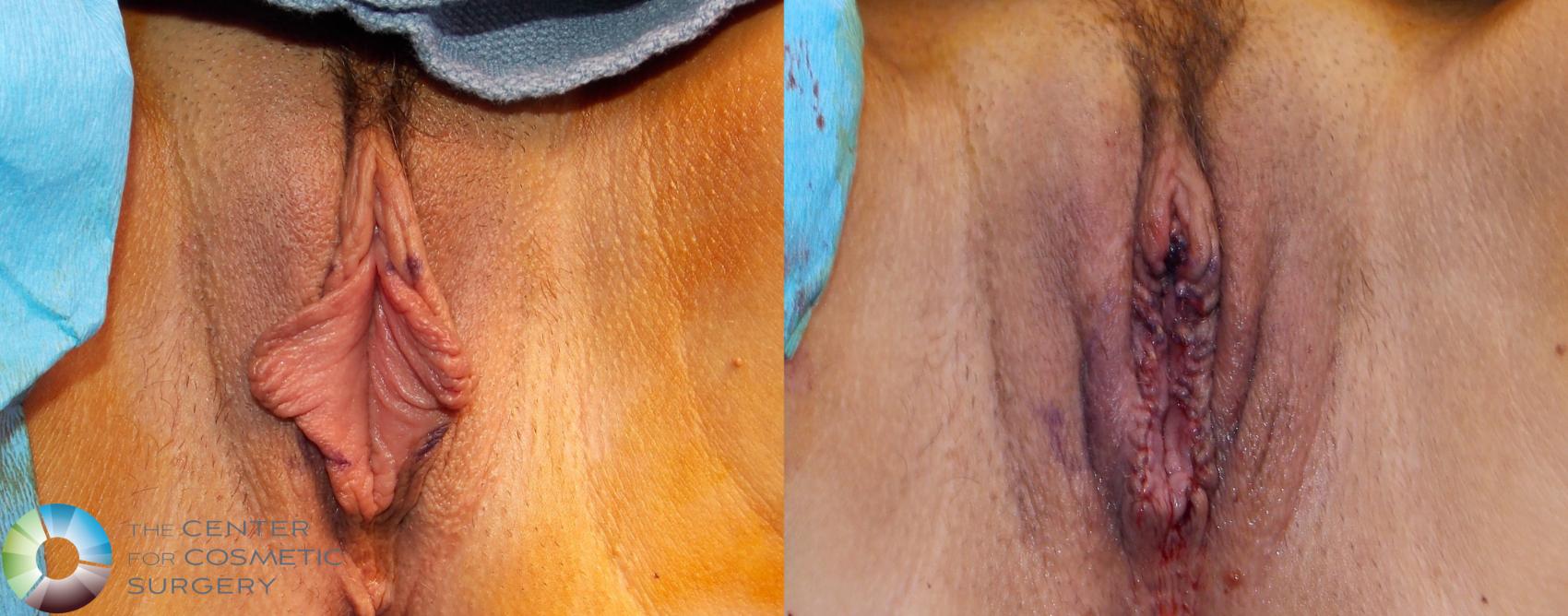 Before & After Labiaplasty Case 739 View #2 View in Denver & Golden, CO