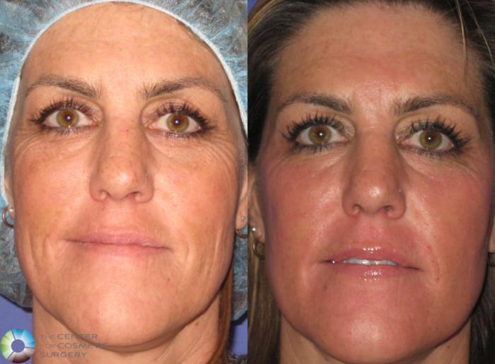 Before & After Laser Skin Resurfacing Case 365 View #1 View in Golden, CO
