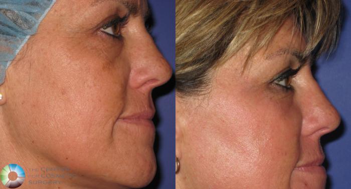 Before & After Laser Skin Resurfacing Case 365 View #2 View in Golden, CO