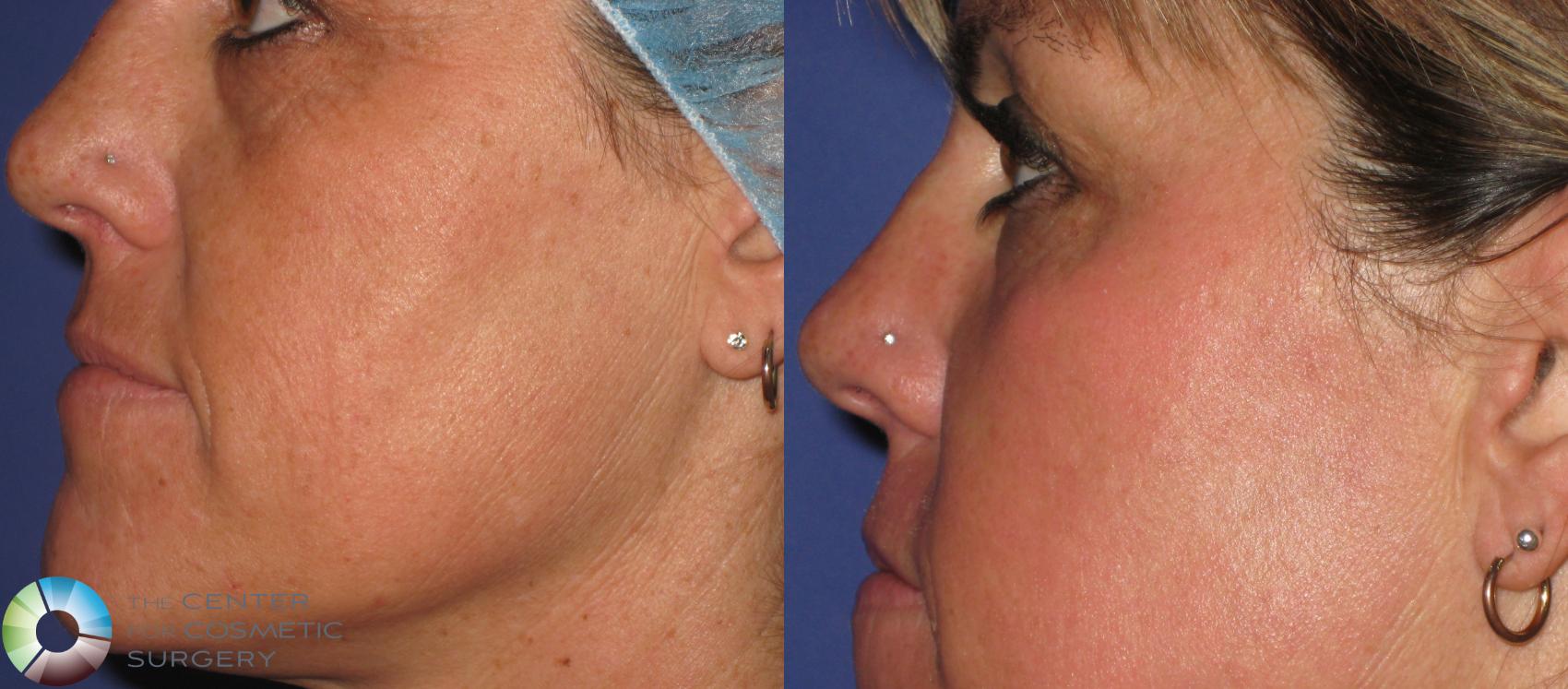 Before & After Laser Skin Resurfacing (WOW) Case 365 View #3 in Denver and Colorado Springs, CO
