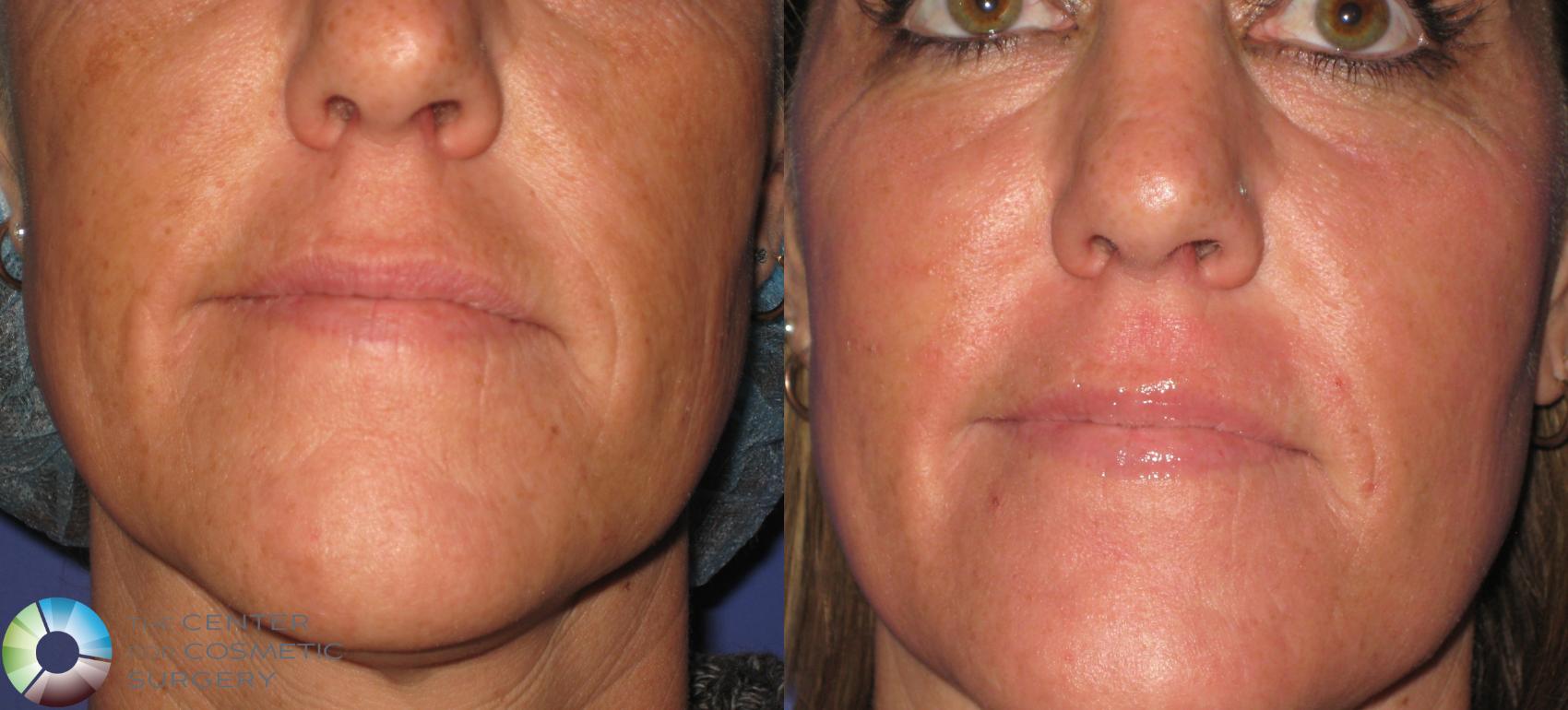 Before & After Laser Skin Resurfacing (WOW) Case 365 View #4 in Denver and Colorado Springs, CO