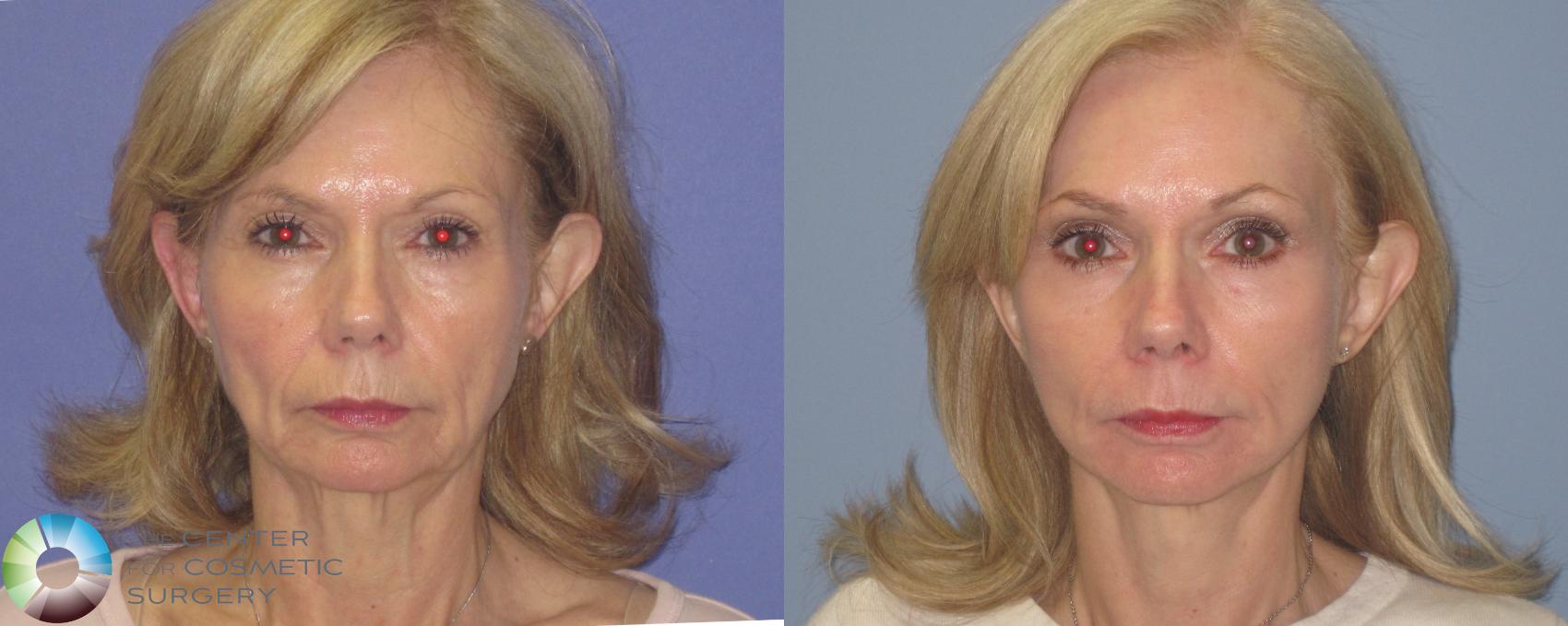 Before & After Facelift Case 460 View #1 in Denver and Colorado Springs, CO