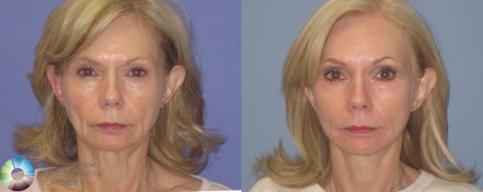 Before & After Mini Facelift Case 460 View #1 View in Golden, CO