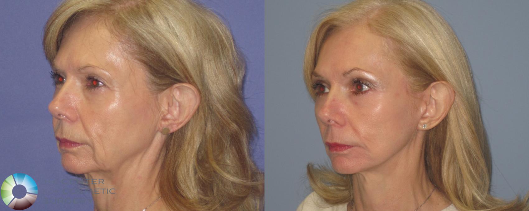 Before & After Laser Skin Resurfacing Case 460 View #2 View in Denver & Golden, CO