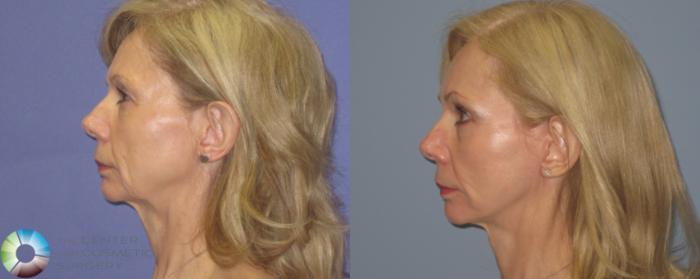 Before & After Mini Facelift Case 460 View #3 View in Golden, CO