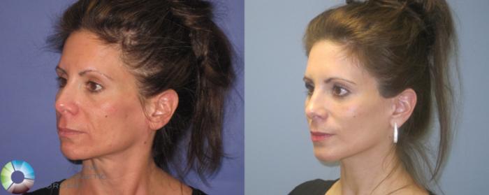 Before & After Mini Facelift Case 462 View #2 View in Golden, CO