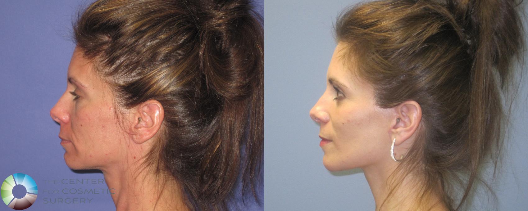 Before & After Laser Skin Resurfacing Case 462 View #3 View in Denver & Golden, CO