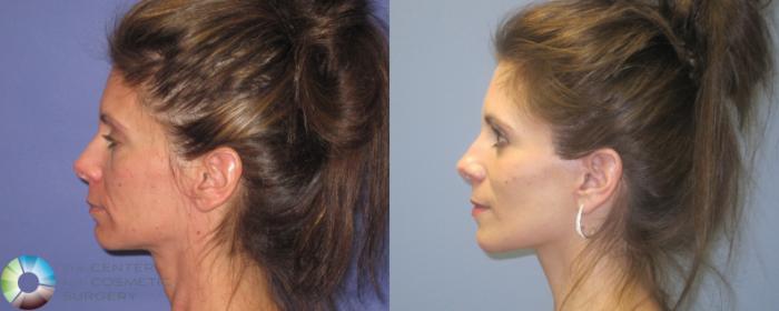 Before & After Mini Facelift Case 462 View #3 View in Golden, CO