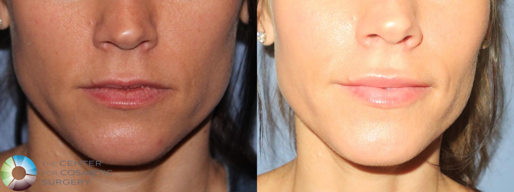 Before & After Lip Augmentation Case 11688 Front View in Golden, CO