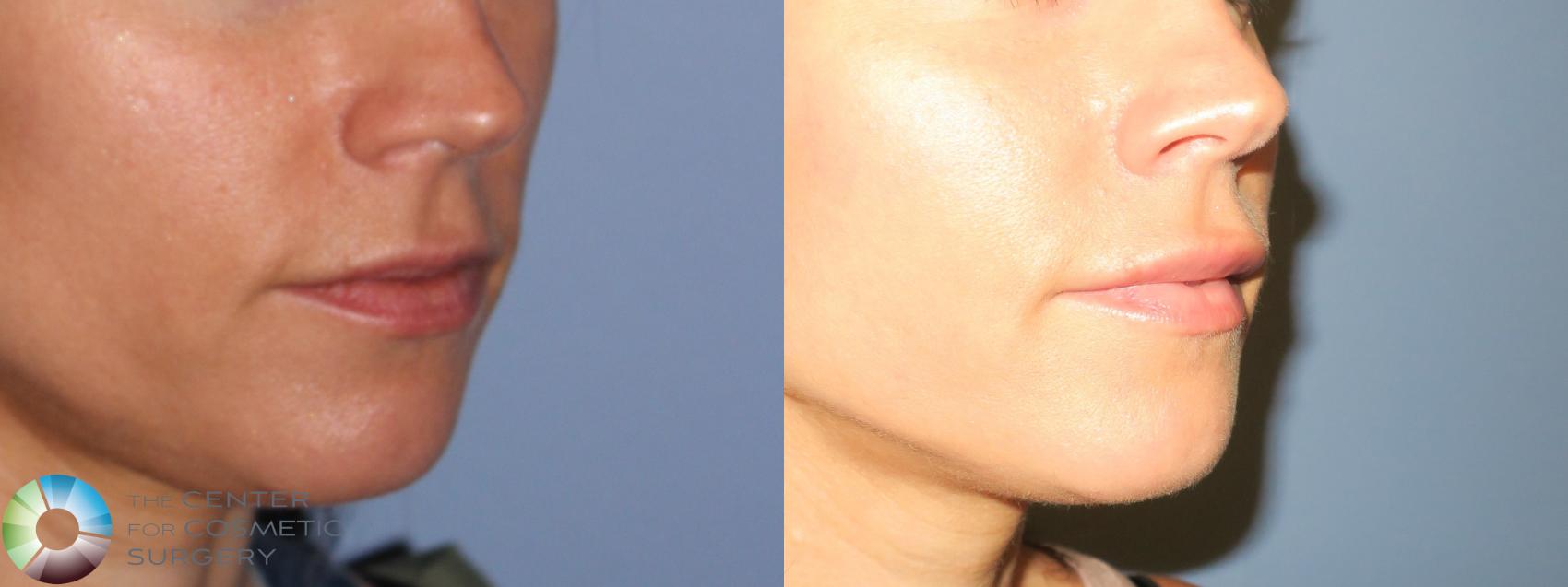 Before & After Lip Augmentation Case 11688 Right Oblique in Denver and Colorado Springs, CO