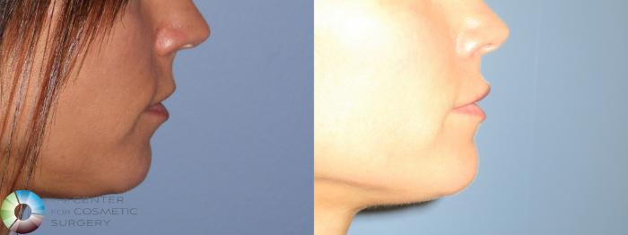 Before & After Lip Augmentation Case 11688 Right Side View in Golden, CO