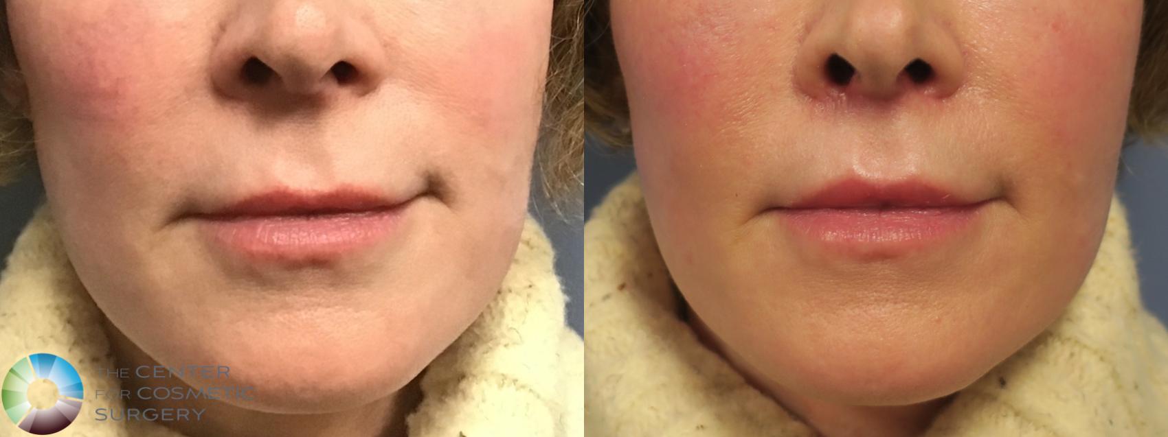 Before & After Lip Augmentation Case 11689 Front in Denver, CO