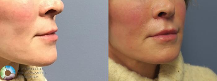 Before & After Lip Augmentation Case 11689 Right Oblique View in Golden, CO