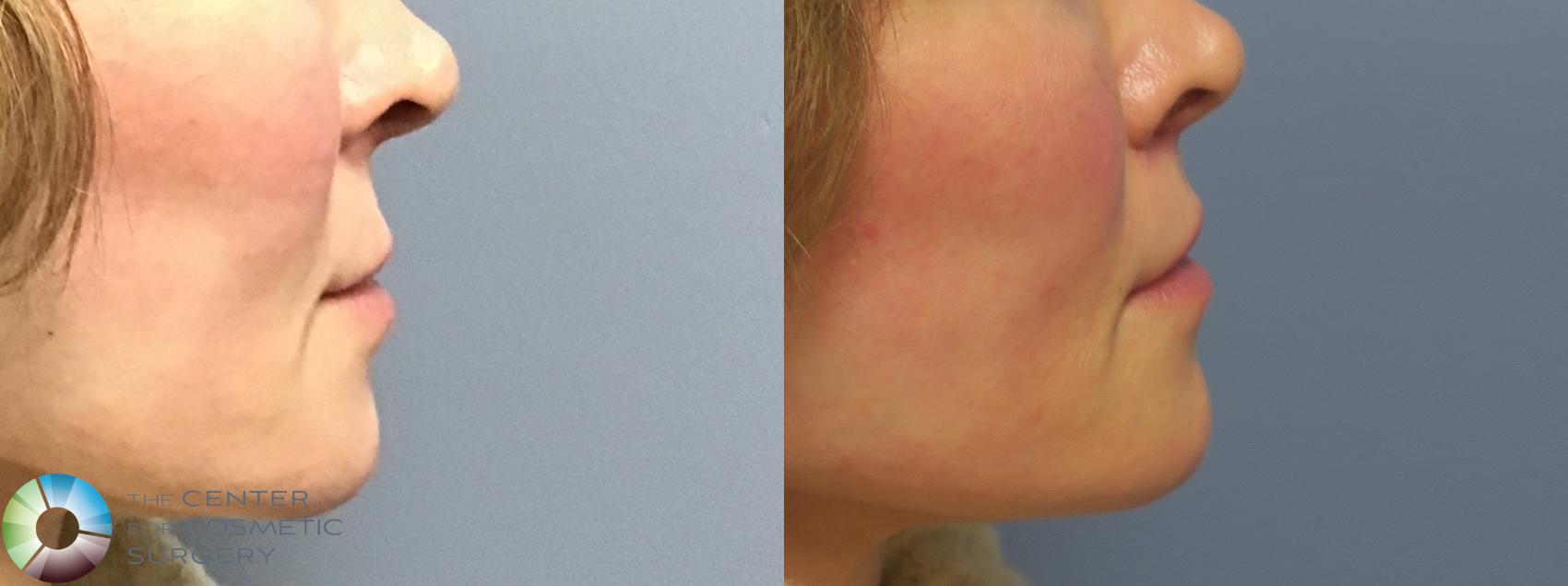 Before & After Lip Augmentation Case 11689 Right Side in Denver and Colorado Springs, CO