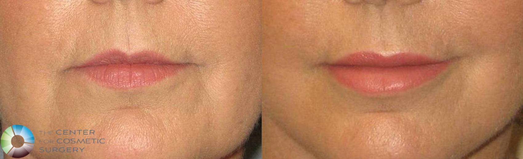 Before & After Lip Augmentation Case 362 View #2 in Denver and Colorado Springs, CO