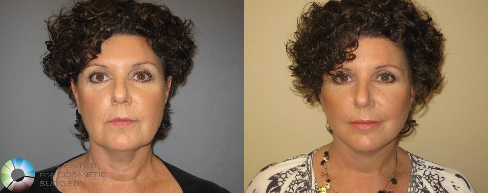 Before & After Lip Augmentation Case 362 View #3 in Denver and Colorado Springs, CO