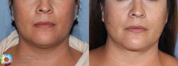 Before & After Liposuction Case 11414 Front in Denver and Colorado Springs, CO