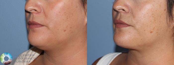 Before & After Neck Lift Case 11414 Left Oblique in Denver and Colorado Springs, CO