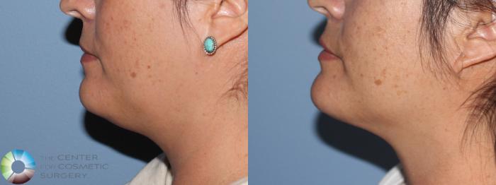Before & After Neck Lift Case 11414 Left Side in Denver and Colorado Springs, CO