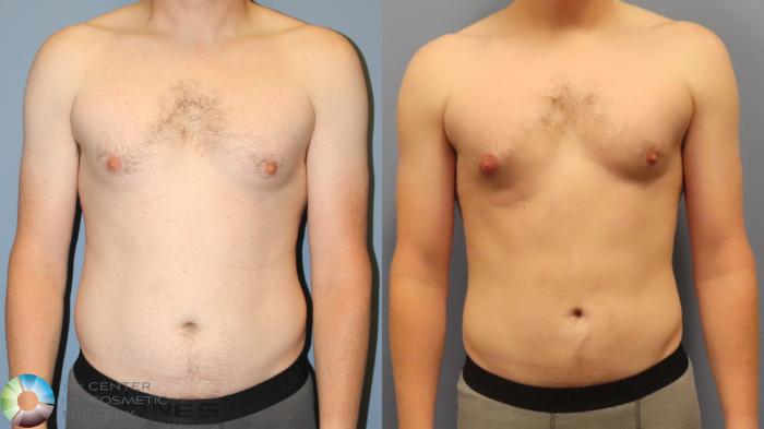 Before & After Liposuction Case 11962 Front in Denver and Colorado Springs, CO