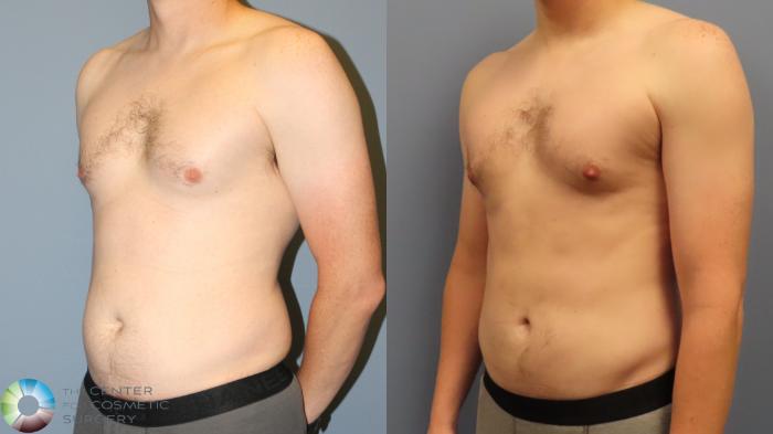 Before & After Power-assisted Liposuction Case 11962 Left Oblique in Denver and Colorado Springs, CO