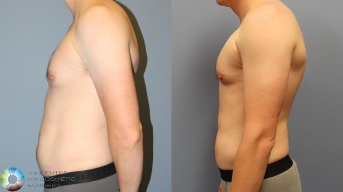 Before & After Liposuction Case 11962 Left Side in Denver and Colorado Springs, CO