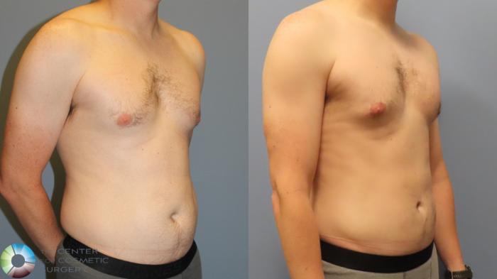 Before & After Liposuction Case 11962 Right Oblique in Denver and Colorado Springs, CO
