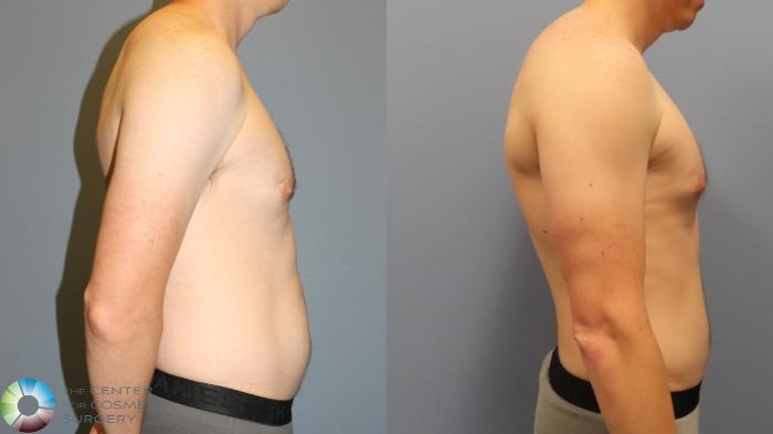 Before & After Liposuction Case 11962 Right Side in Denver and Colorado Springs, CO
