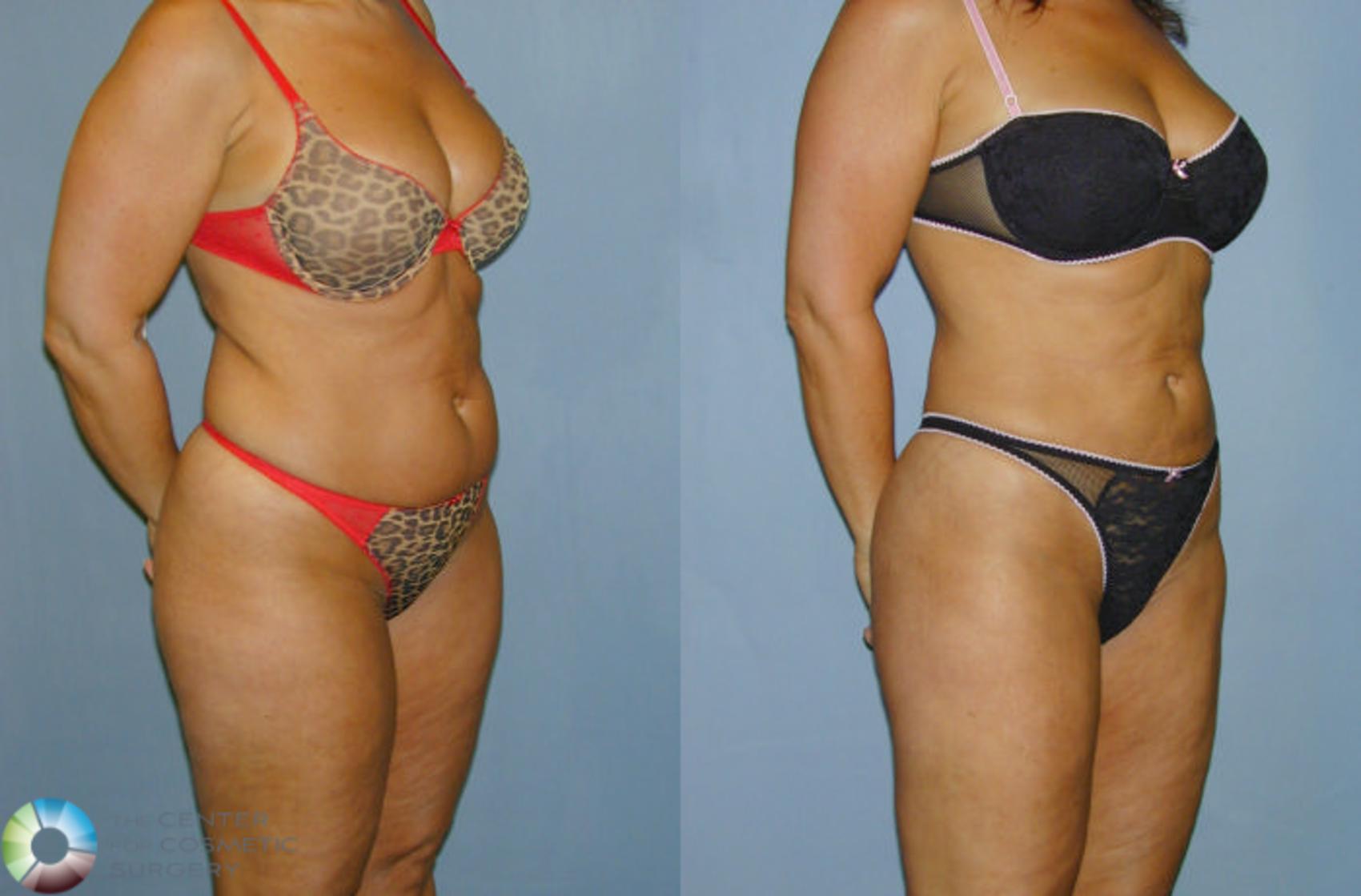 Before & After Liposuction Case 12 View #1 in Denver and Colorado Springs, CO