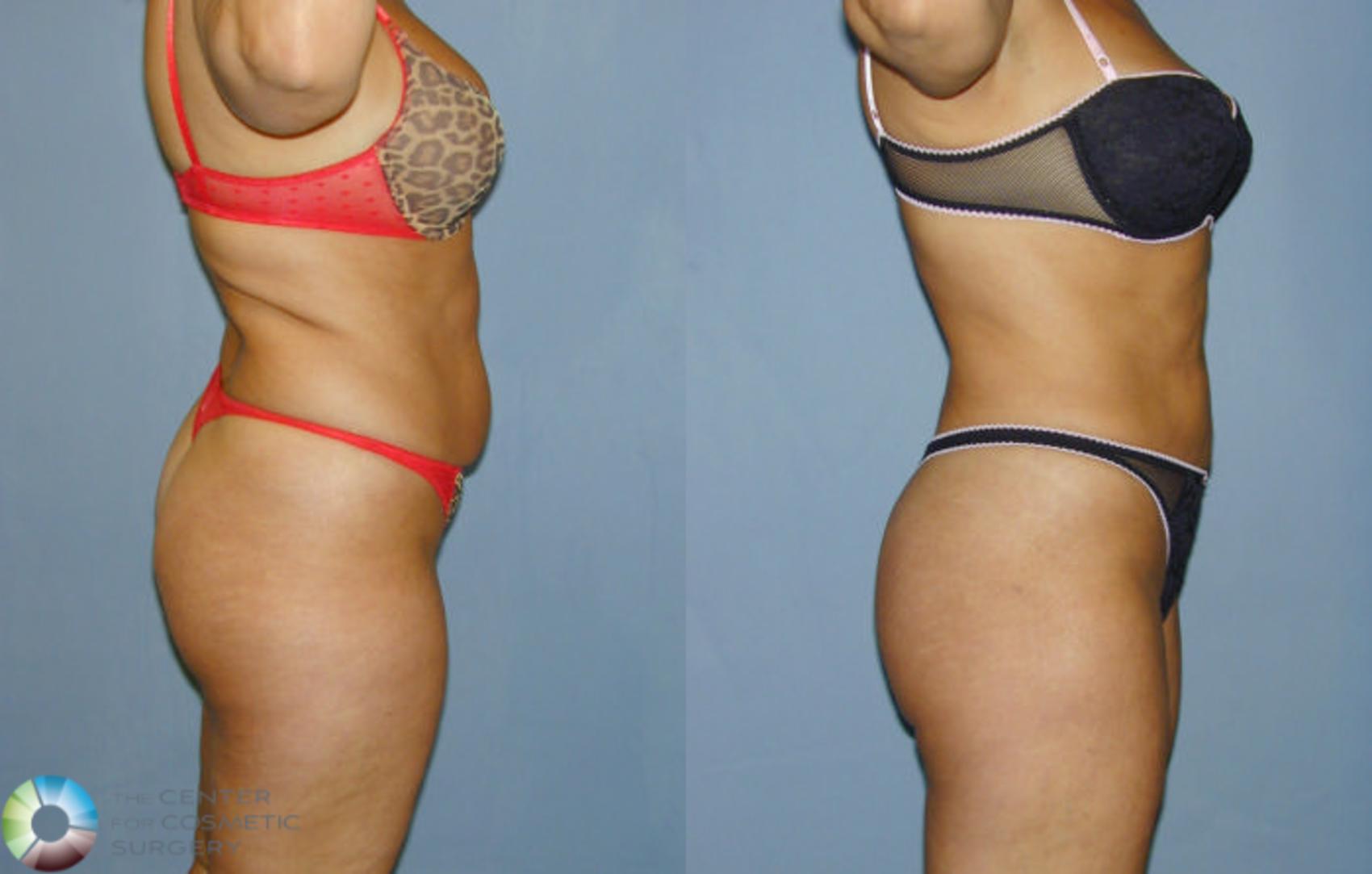 Before & After Liposuction Case 12 View #2 View in Golden, CO
