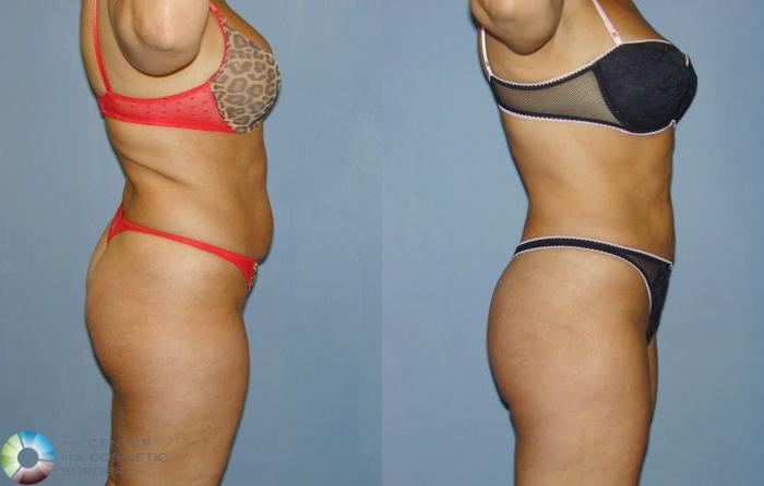 Before & After Power-assisted Liposuction Case 12 View #2 View in Golden, CO