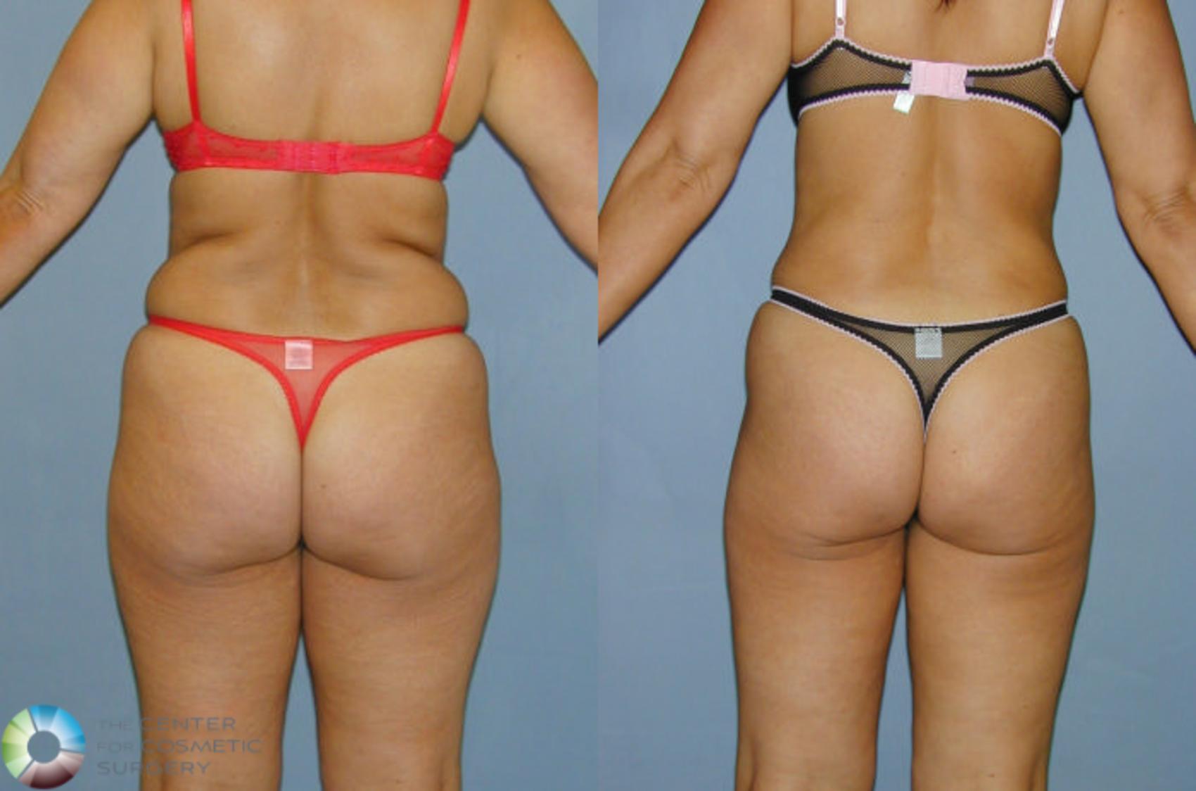 Before & After Liposuction Case 12 View #3 View in Golden, CO