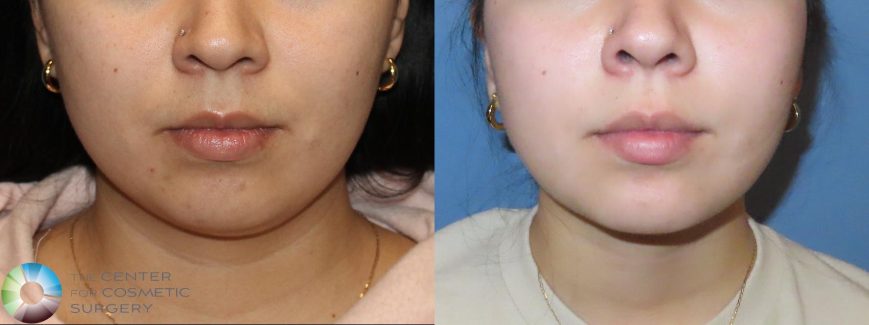Before & After Liposuction Case 12127 Front in Denver and Colorado Springs, CO