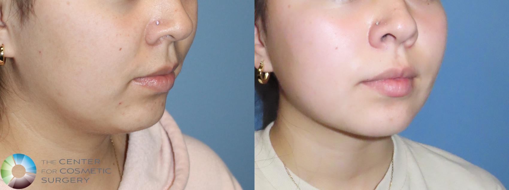 Before & After Liposuction Case 12127 Right Oblique in Denver and Colorado Springs, CO