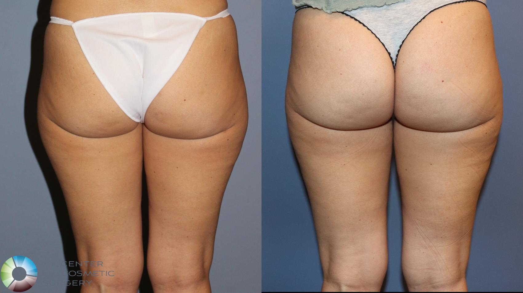 Before & After Liposuction Case 12140 Back in Denver and Colorado Springs, CO