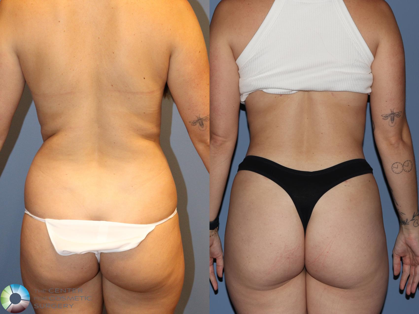 Before & After Power-Assisted Liposuction Case 12186 Back in Denver and Colorado Springs, CO