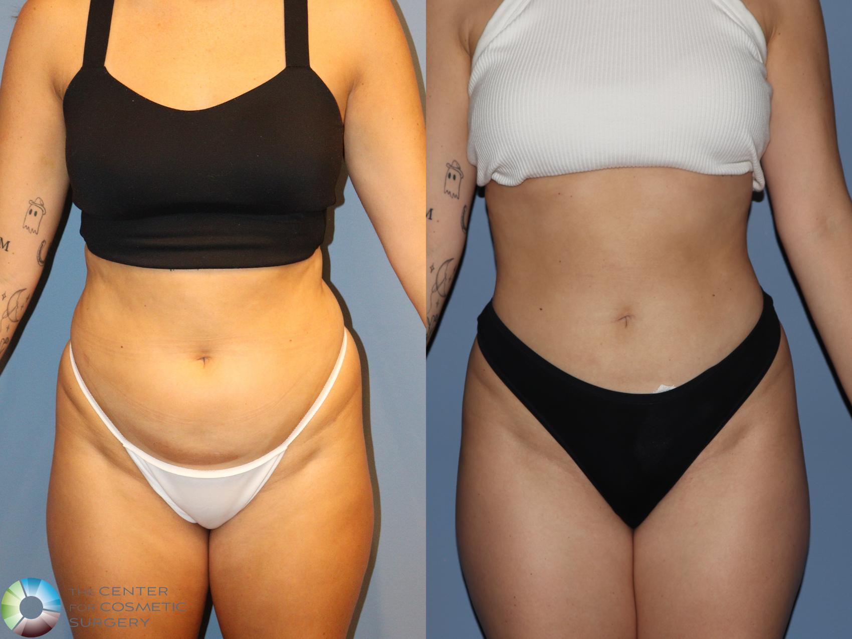 Before & After Liposuction Case 12186 Front in Denver and Colorado Springs, CO