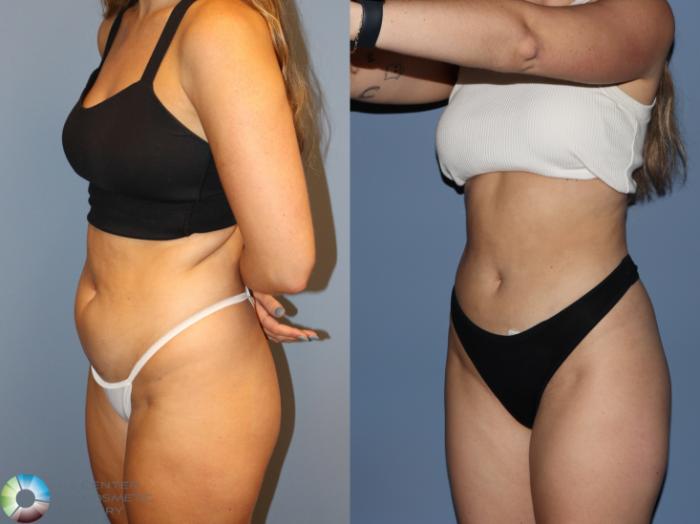 Before & After Power-Assisted Liposuction Case 12186 Left Oblique in Denver and Colorado Springs, CO