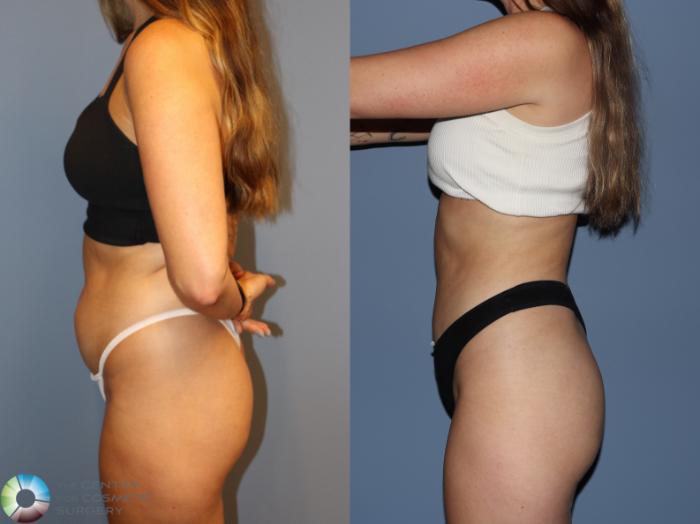 Before & After Power-Assisted Liposuction Case 12186 Left Side in Denver and Colorado Springs, CO