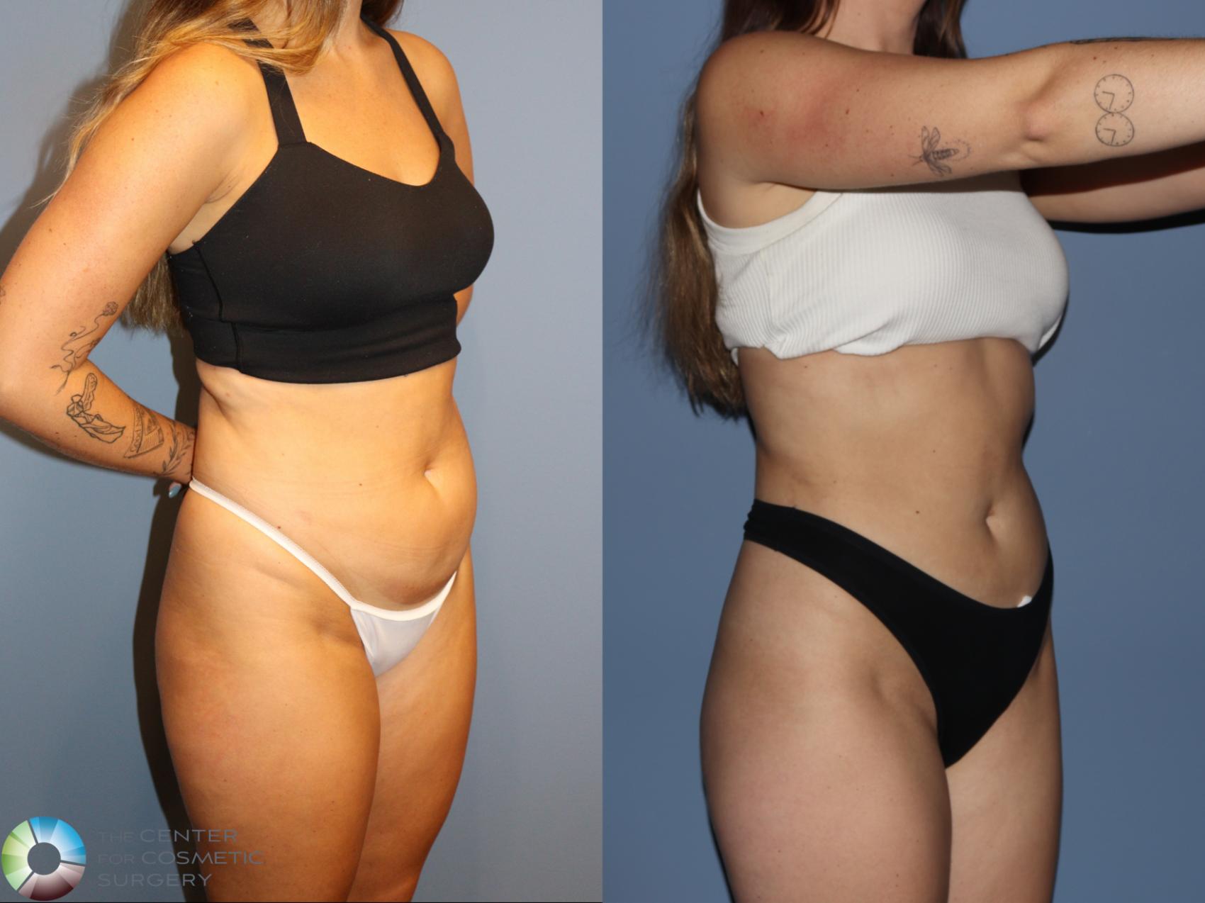 Before & After Liposuction Case 12186 Right Oblique in Denver and Colorado Springs, CO