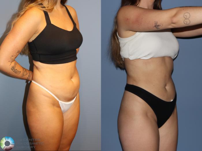 Before & After Power-Assisted Liposuction Case 12186 Right Oblique in Denver and Colorado Springs, CO