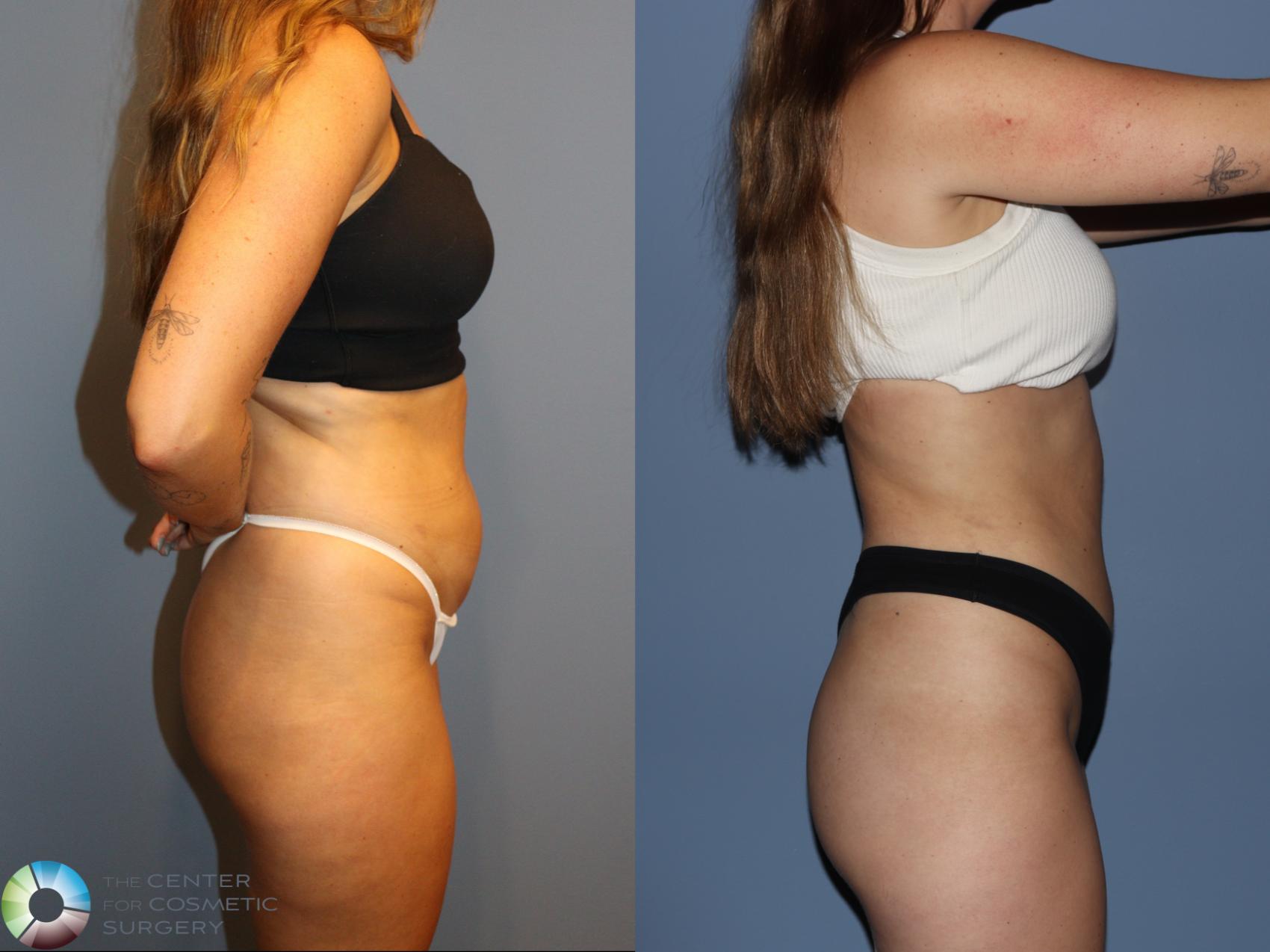 Before & After Liposuction Case 12186 Right Side in Denver and Colorado Springs, CO