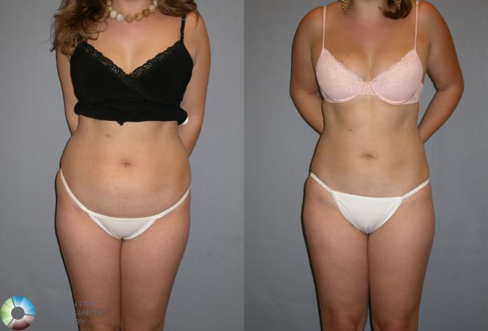 Before & After Power-assisted Liposuction Case 128 View #2 in Denver, CO