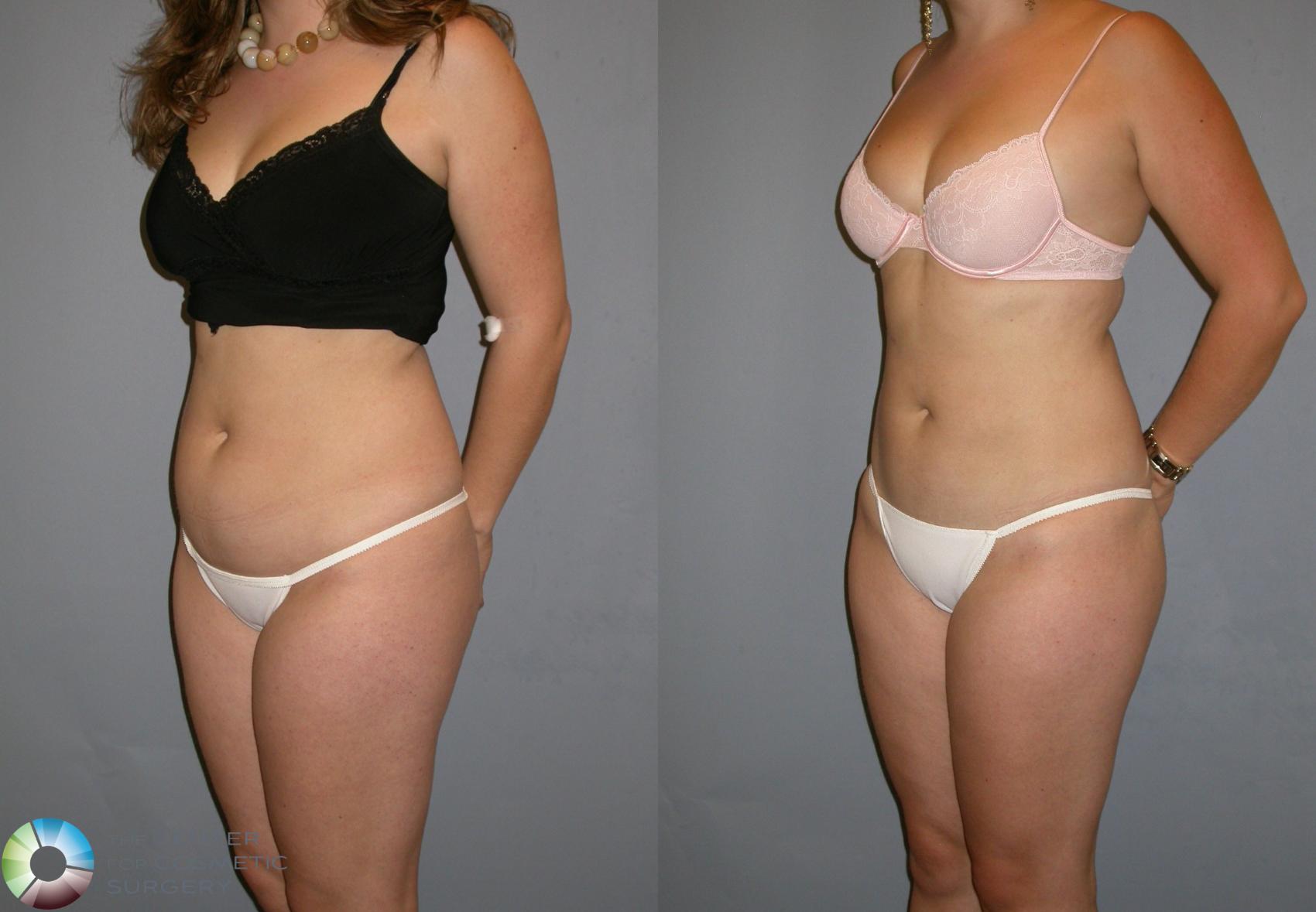 Before & After Liposuction Case 128 View #3 in Denver and Colorado Springs, CO