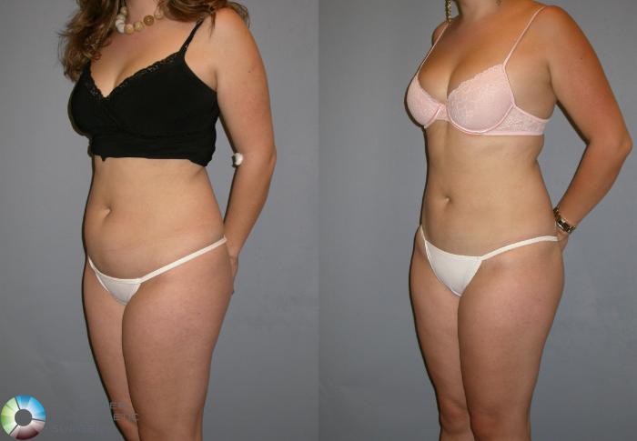 Before & After Power-assisted Liposuction Case 128 View #3 in Denver, CO