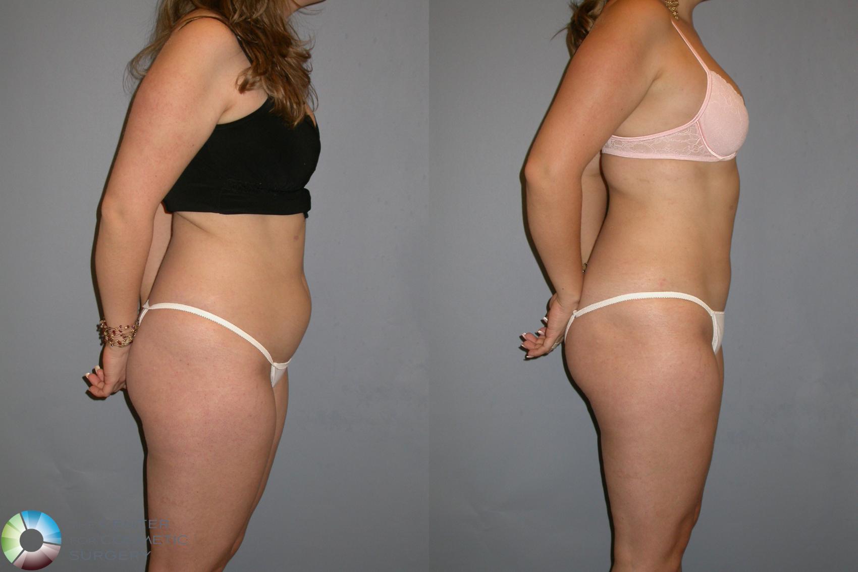 Before & After Liposuction Case 128 View #4 in Denver and Colorado Springs, CO