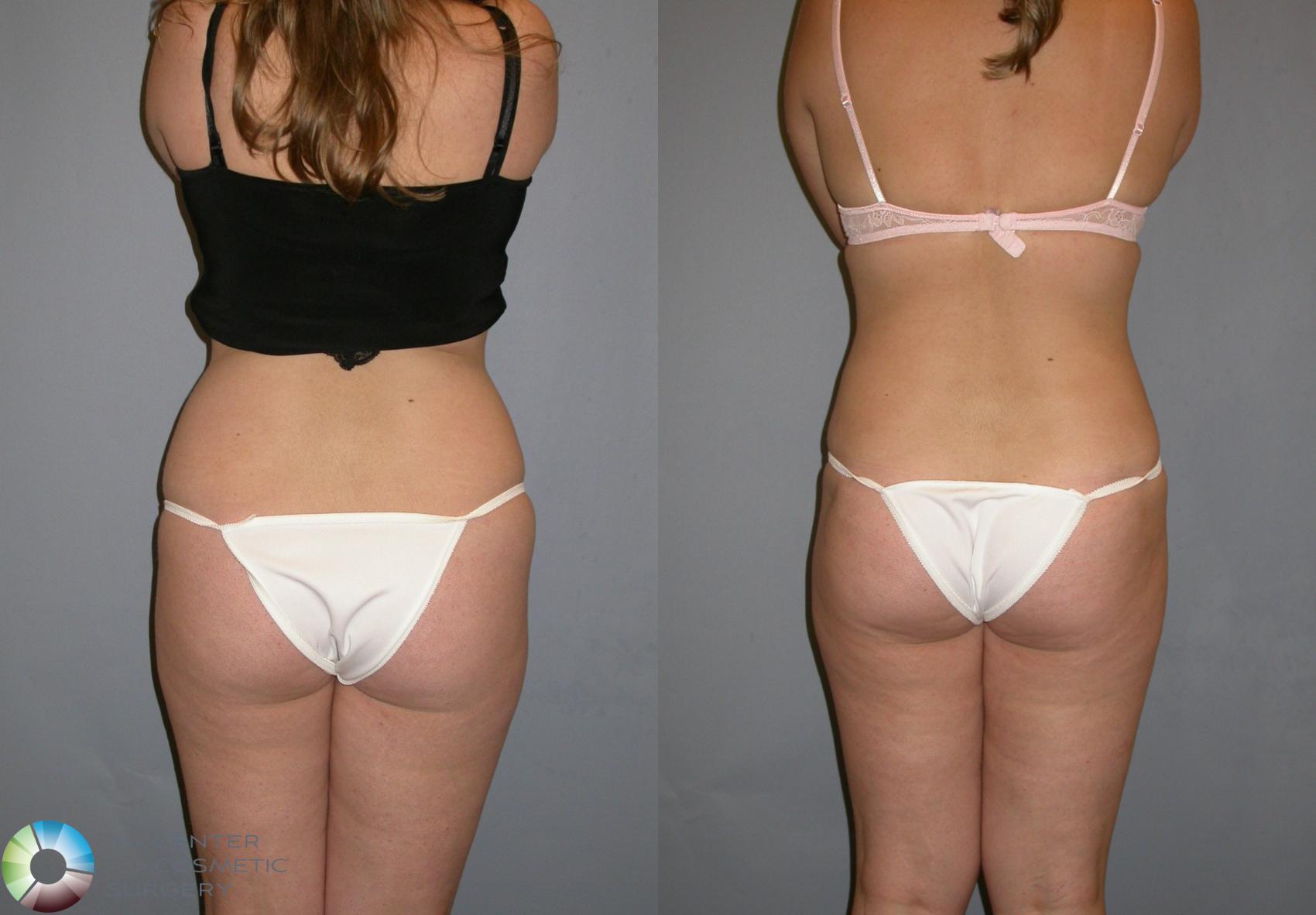 Before & After Liposuction Case 128 View #5 in Denver and Colorado Springs, CO